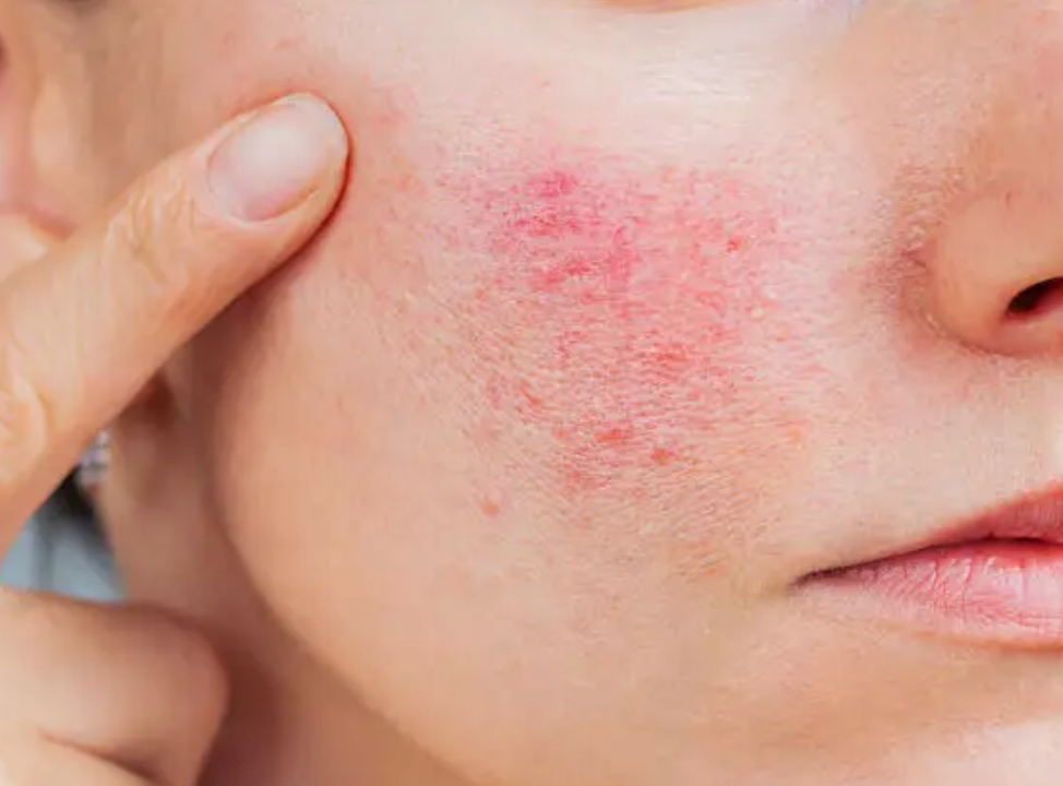 Rosacea treatment