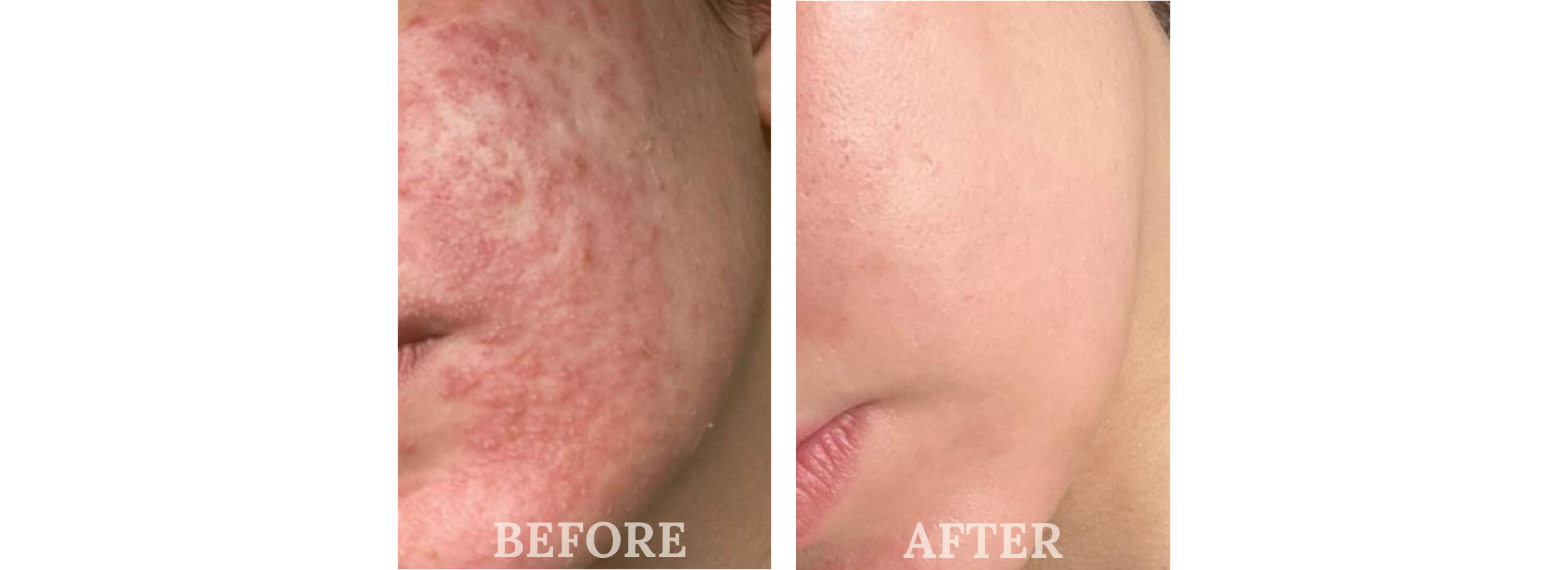 A Natural Difference Skincare EU Certified Before & After