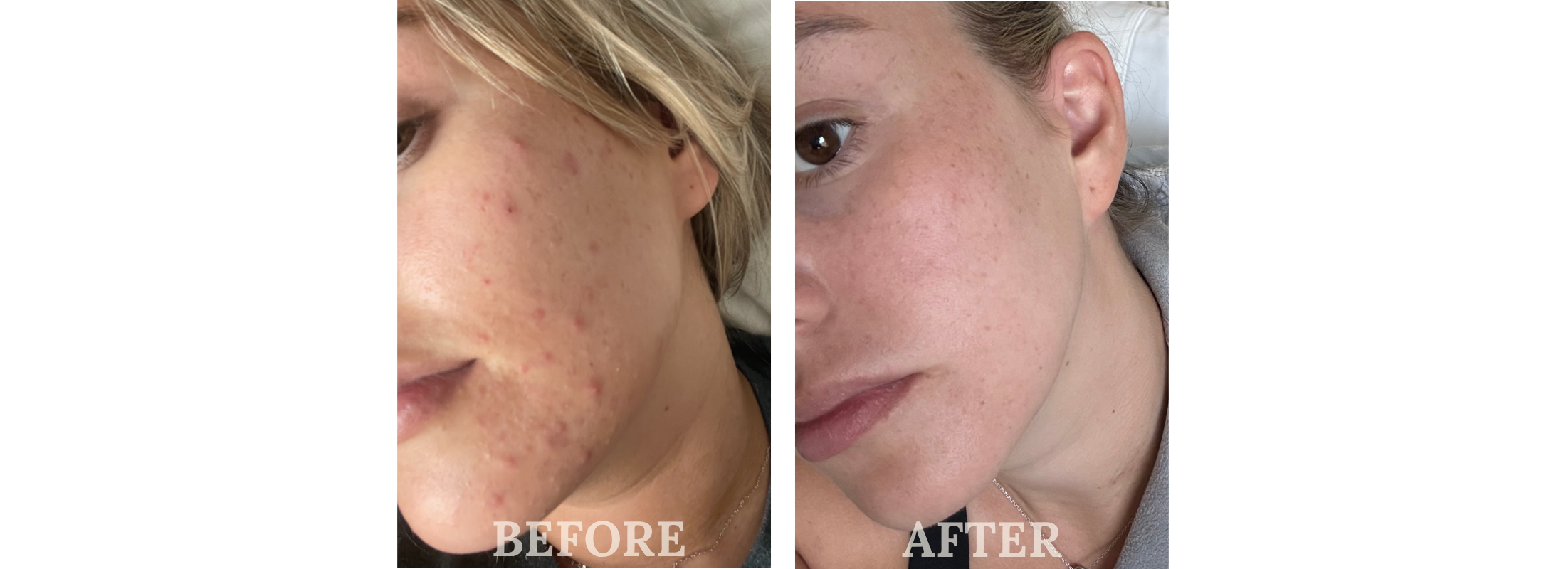 A Natural Difference Skincare EU Certified Before & After
